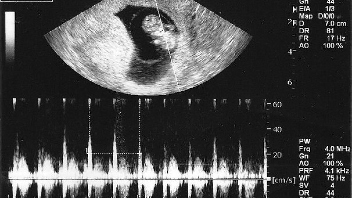 Unplanned Pregnancy? Why You Need an Ultrasound